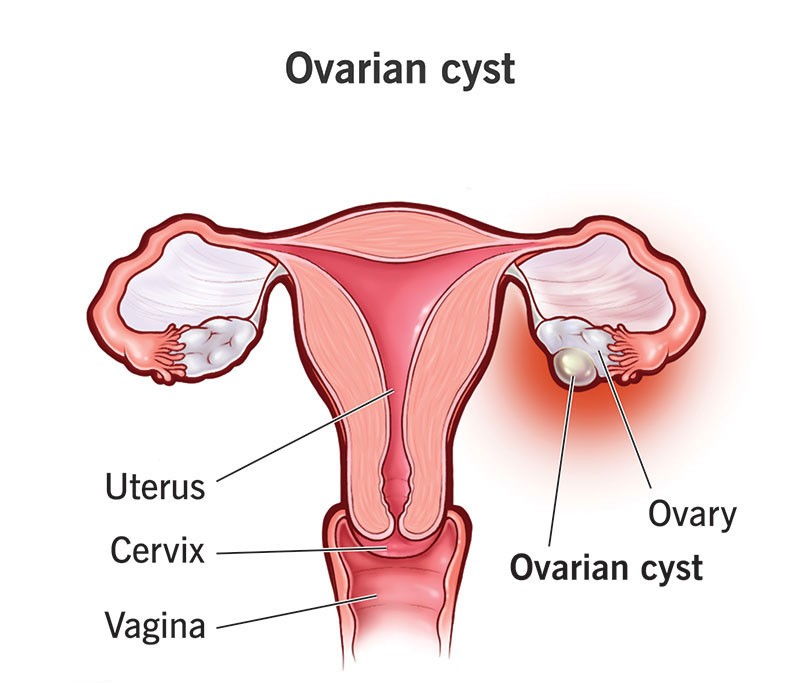 ovarian-cysts