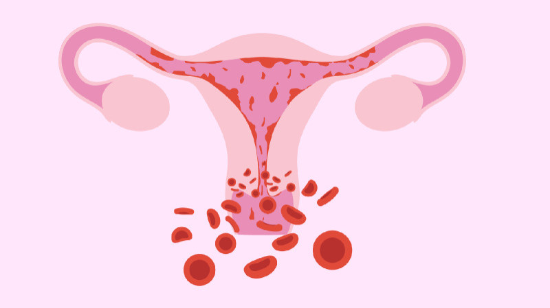 Heavy-Menstrual-Bleeding