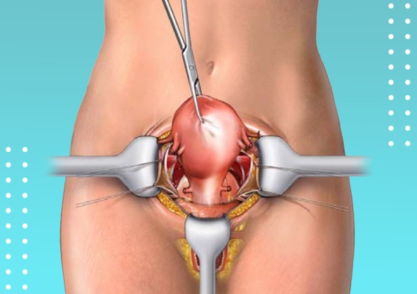 Hysterectomy