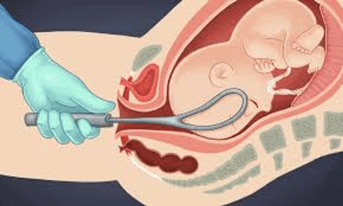 Instrumental Delivery