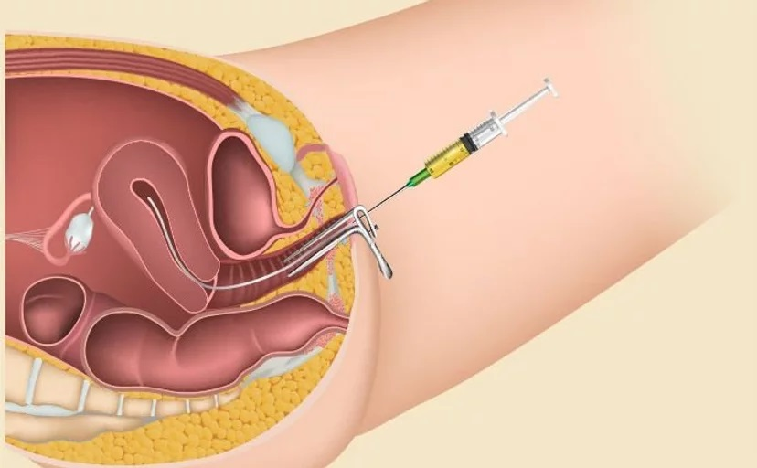 Intra-Uterine-Insemination