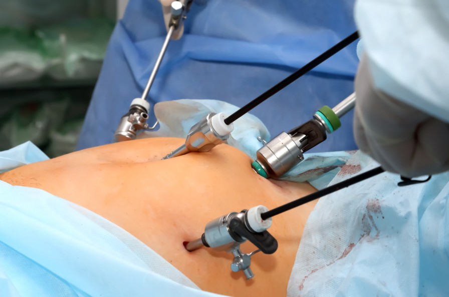 Laparoscopic Hysterectomy​​
