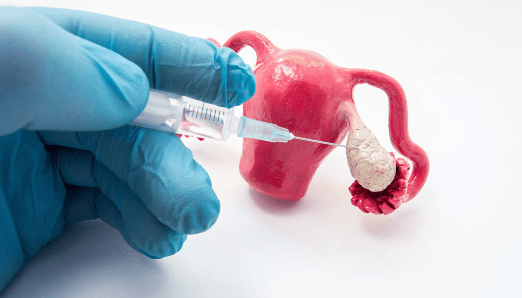 ovulation-induction