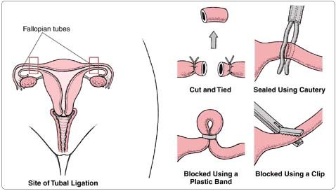 Sterilization procedure
